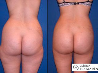 Antes y después lipoescultura marin
