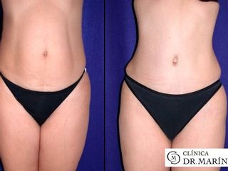 Antes y despues de abdominopl