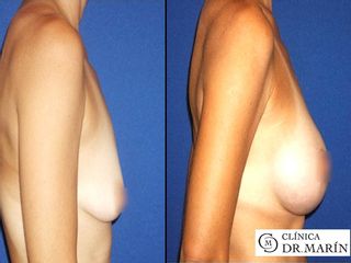 Antes y despues de levantamiento de pecho con protesis mamarias