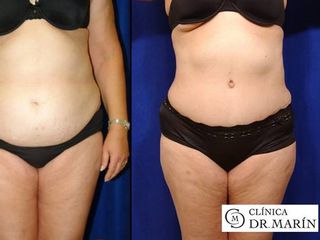 Antes y despues de abdominoplastia