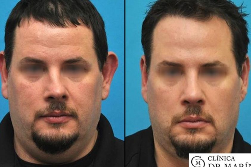 Otoplastia antes y después - 595801