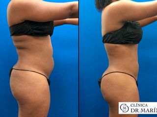 Antes y despues de Lipoescultura