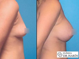 Antes y despues de aumento de pecho con implantes redondos