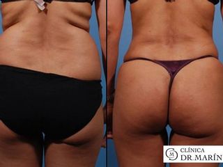 Antes y despues de Lipoescultura