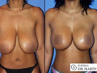 Antes y despues de reduccion de mamas