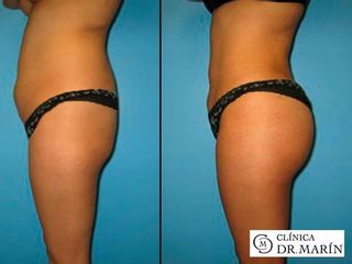 Antes y despues de aumento de glúteos con macrolane