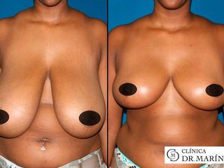 Antes y despues de mamoplastia de reduccion