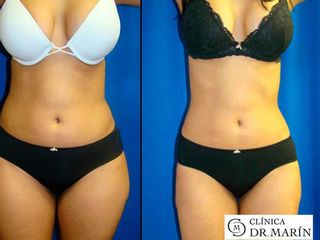 Antes y despues de lipoescultura