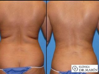 Antes y despues de lipoescultura