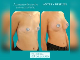 Clínica Dr. Pascual Marín - Aumento de pecho