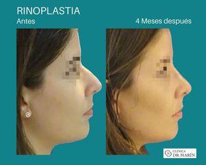 Rinoplastia - Clínica Dr. Pascual Marín