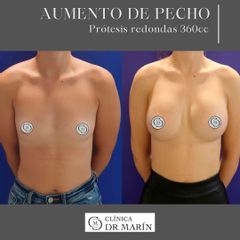Aumento de pecho - Clínica Dr. Pascual Marín