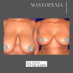 Mastopexia - Clínica Dr. Pascual Marín