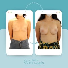 Aumento de pecho - Clínica Dr. Pascual Marín
