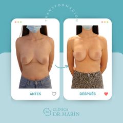 Aumento de pecho - Clínica Dr. Pascual Marín
