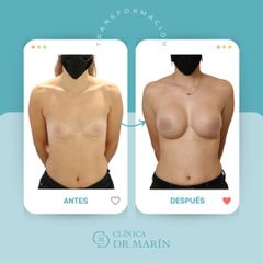 Aumento de pecho - Clínica Dr. Pascual Marín