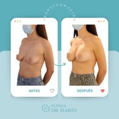 Aumento de pecho - Clínica Dr. Pascual Marín