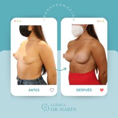 Aumento de pecho - Clínica Dr. Pascual Marín