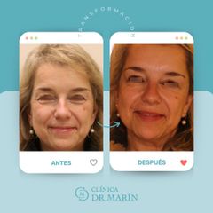Blefaroplastia - Clínica Dr. Pascual Marín