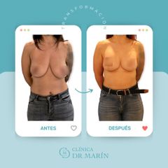 Reducción senos - Clínica Dr. Pascual Marín