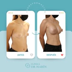 Aumento de pecho - Clínica Dr. Pascual Marín