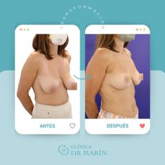 Reducción senos - Clínica Dr. Pascual Marín