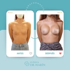 Aumento de pecho - Clínica Dr. Pascual Marín