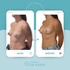 Aumento de pecho - Clínica Dr. Pascual Marín