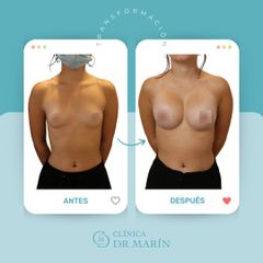 Aumento de pecho - Clínica Dr. Pascual Marín