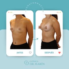 Aumento de pecho - Clínica Dr. Pascual Marín
