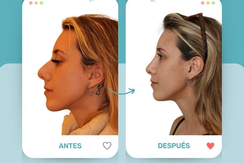 Rinoplastia antes y después - 862254