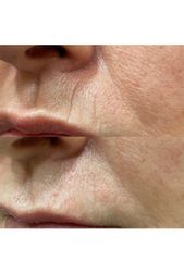 Atenuación arrugas labio superior - The Facial Concept
