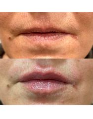Aumento de labios - The Facial Concept