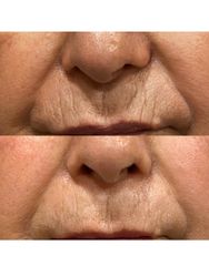Rellenos faciales - The Facial Concept