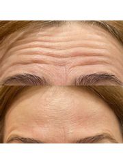 Atenuación arrugas frontales - The Facial Concept