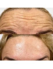 Tratamiento arrugas de la frente - The Facial Concept