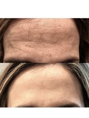 Atenuación de arrugas frontales - The Facial Concept