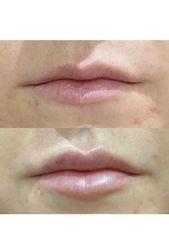 Aumento de labios - The Facial Concept