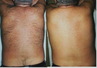 Antes y después Depilación láser