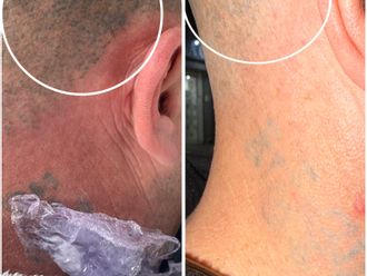 Eliminación de tatuajes antes y después - 878948