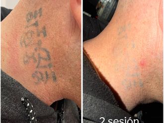 Eliminación de tatuajes antes y después - 878949