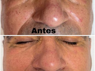 Tratamiento antimanchas antes y después - 878951