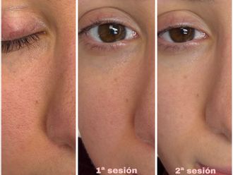 Peeling antes y después - 878953