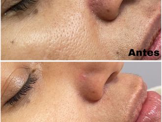 Mesoterapia antes y después - 878954
