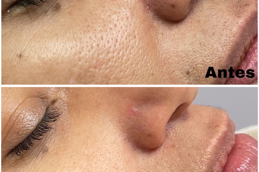 Mesoterapia antes y después - 878954