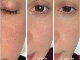 Peeling antes y después - 878970