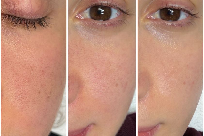 Peeling antes y después - 878970