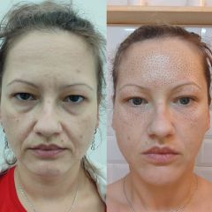 Plasmapen rejuvenecimiento facial - Sapphira Privé BCN