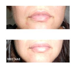 Aumento de labios - MEDINAE SALUD