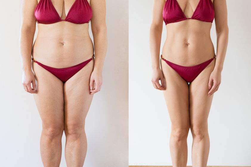 Tratamiento obesidad antes y después - 838520